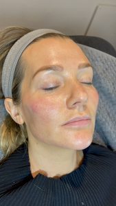 Profhilo treatment